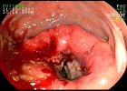 Adenocarcinoma de Recto Px de 28 A